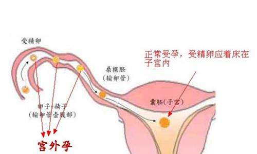 导致宫外孕的主要原因有哪些