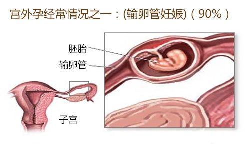 宫外孕早期症状特点及诊断方法